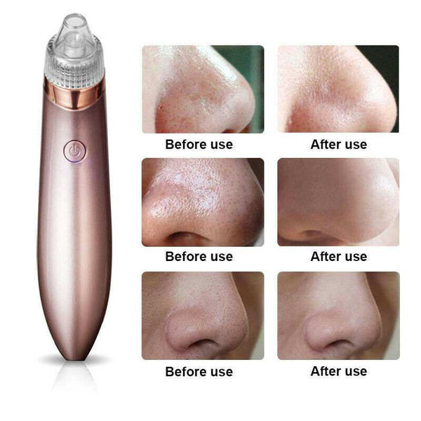 Electric Blackhead Vacuum Pore Cleaner - Strong Suction Tool